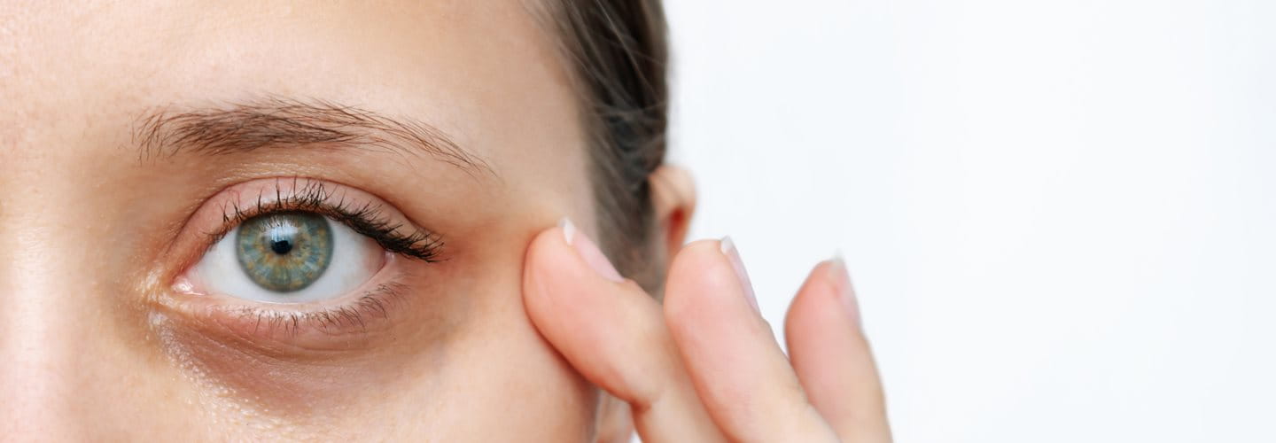 Cienie pod oczami przyczyny