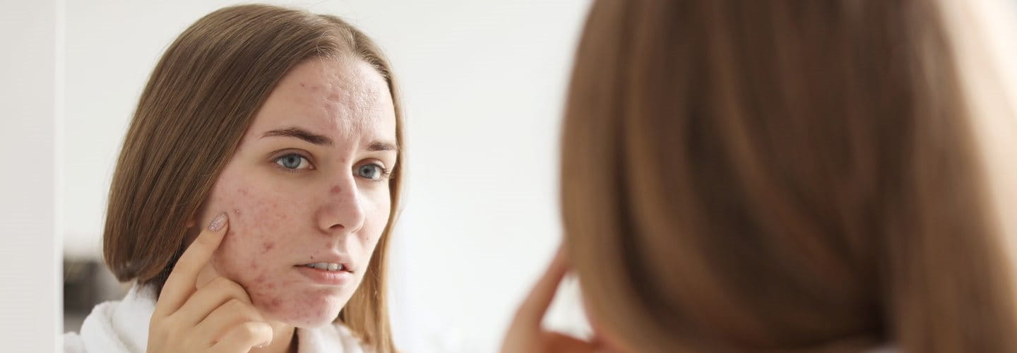 kwas salicylowy na trądzik