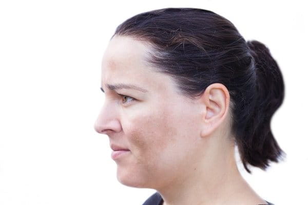 melasma co to