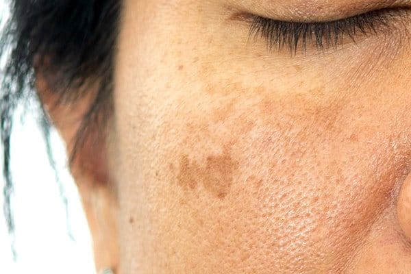 melasma przebarwienia na twarzy