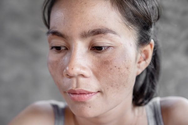 melasma przebarwienia na twarzy