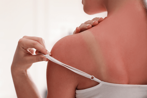 Oparzenia słoneczne - czym smarować