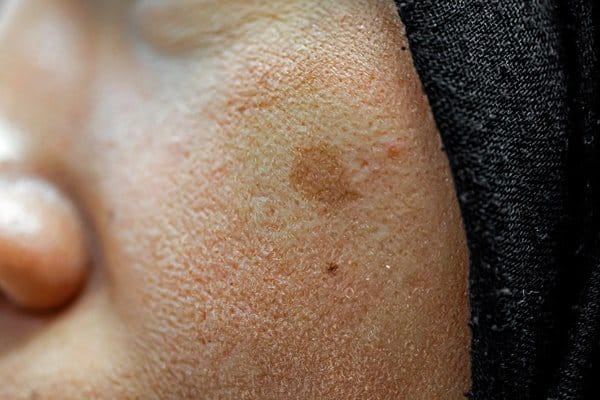 ciążowa ostuda na twarzy