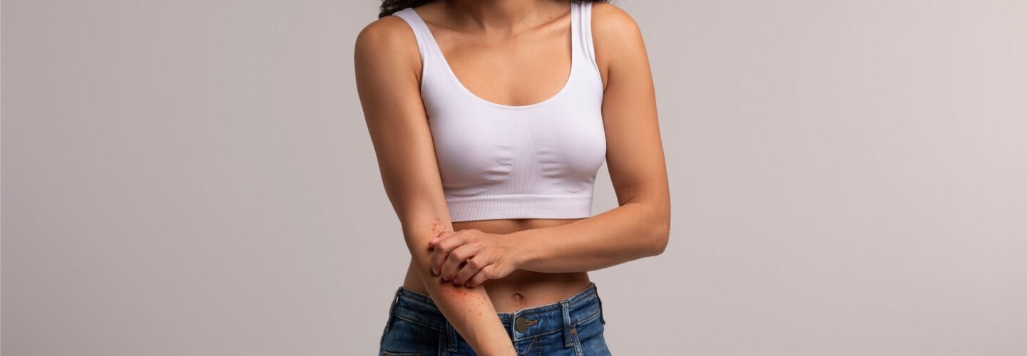 pokrzywka na skórze