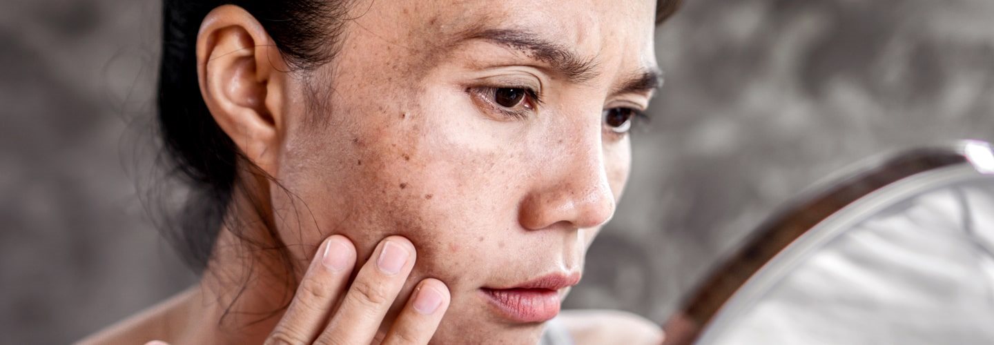przebarwienia po ciąży na twarzy
