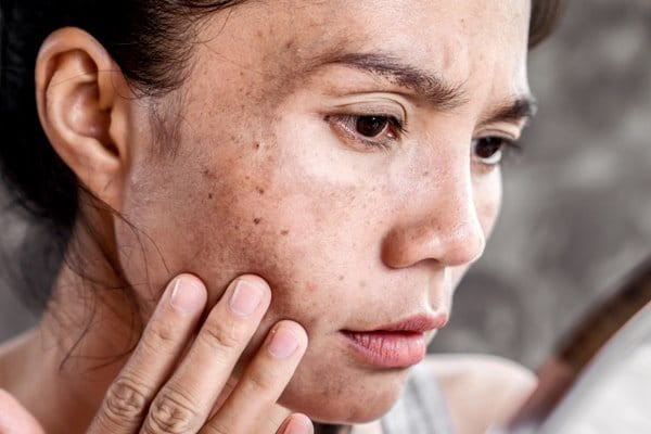 przebarwienia po ciąży na twarzy