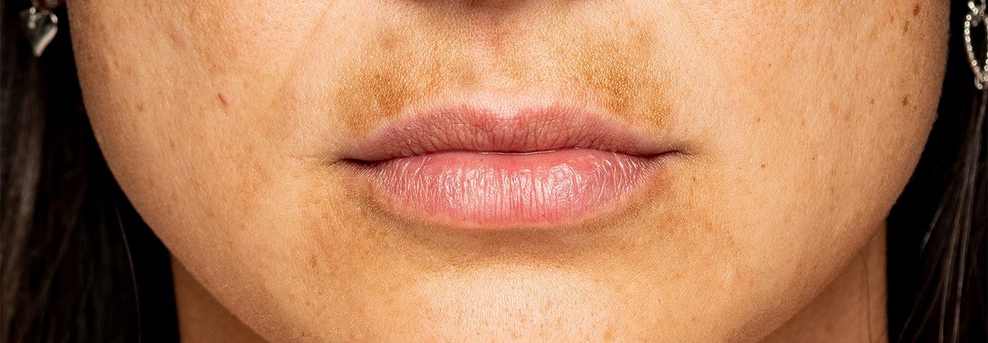 Co na przebarwienia na twarzy