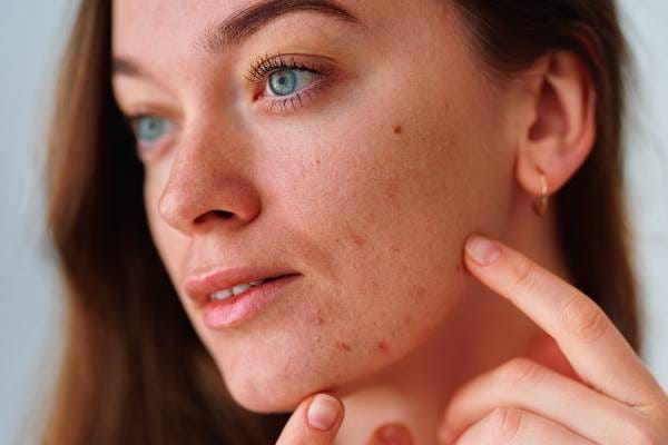 Sebum