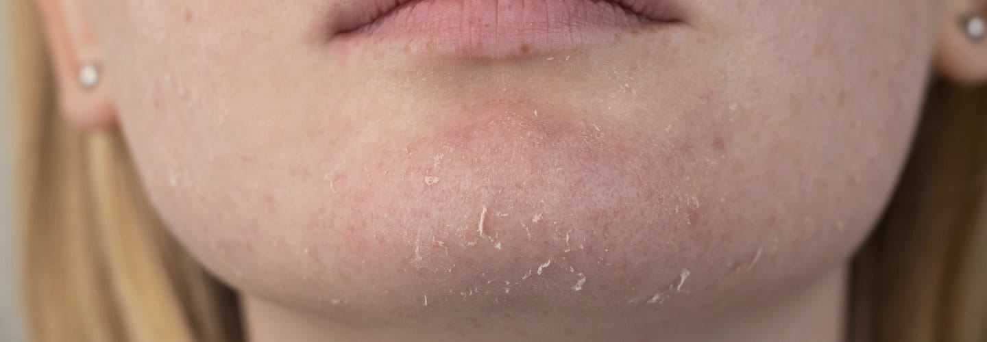 Suche skórki na twarzy