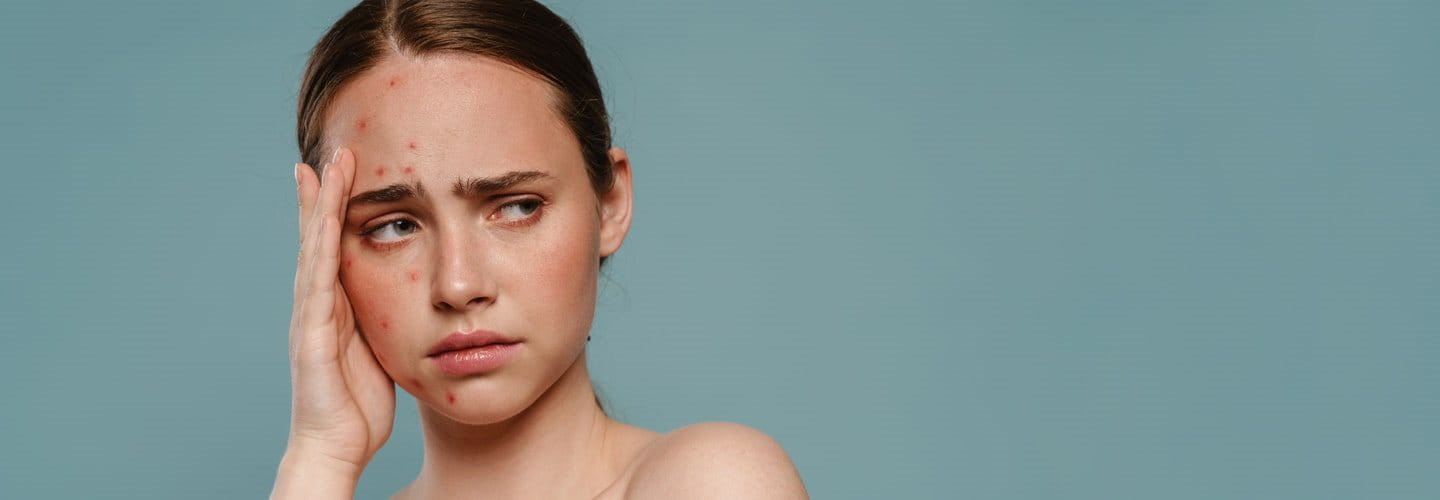trądzik hormonalny