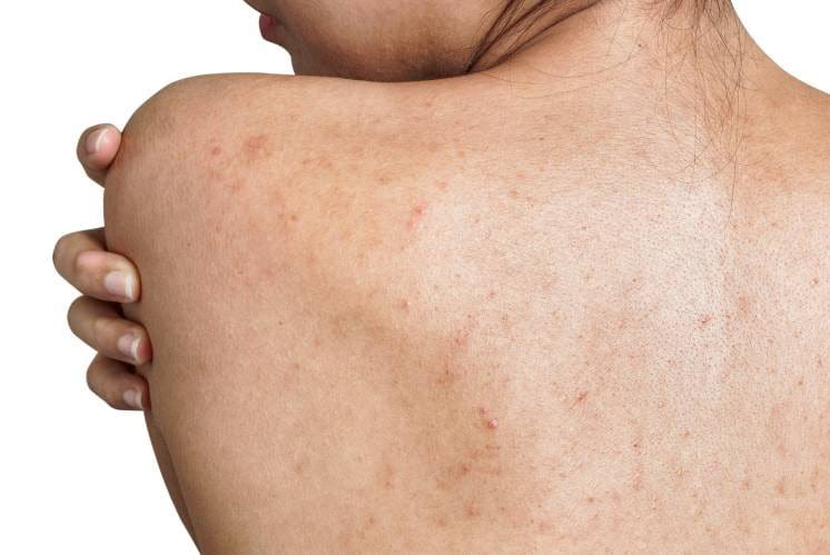 Trądzik na plecach