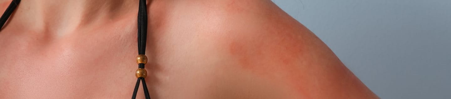 Uczulenie na słońce