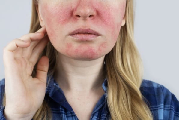 uczulenie na słońce