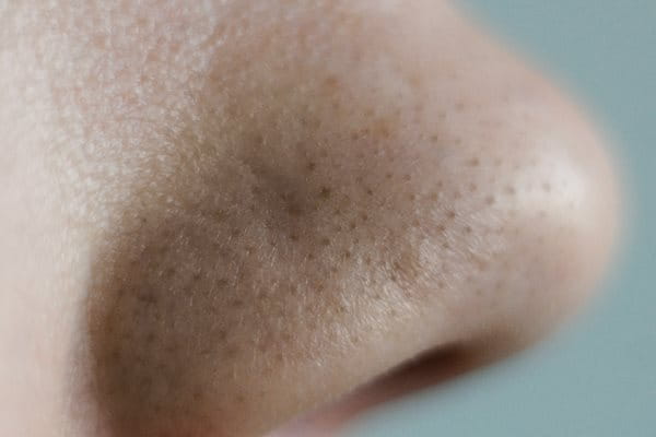 Wągry na nosie jak się pozbyć