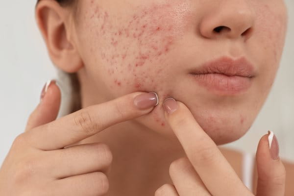 Czy wyciskanie pryszczy jest dobre