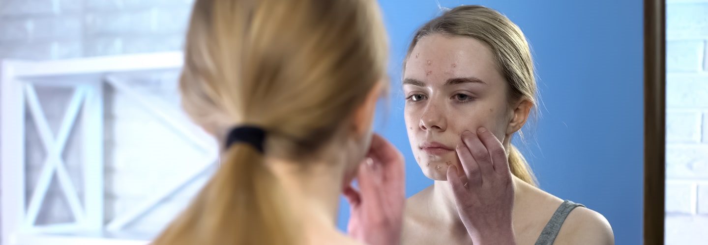 zaskórniki na twarzy