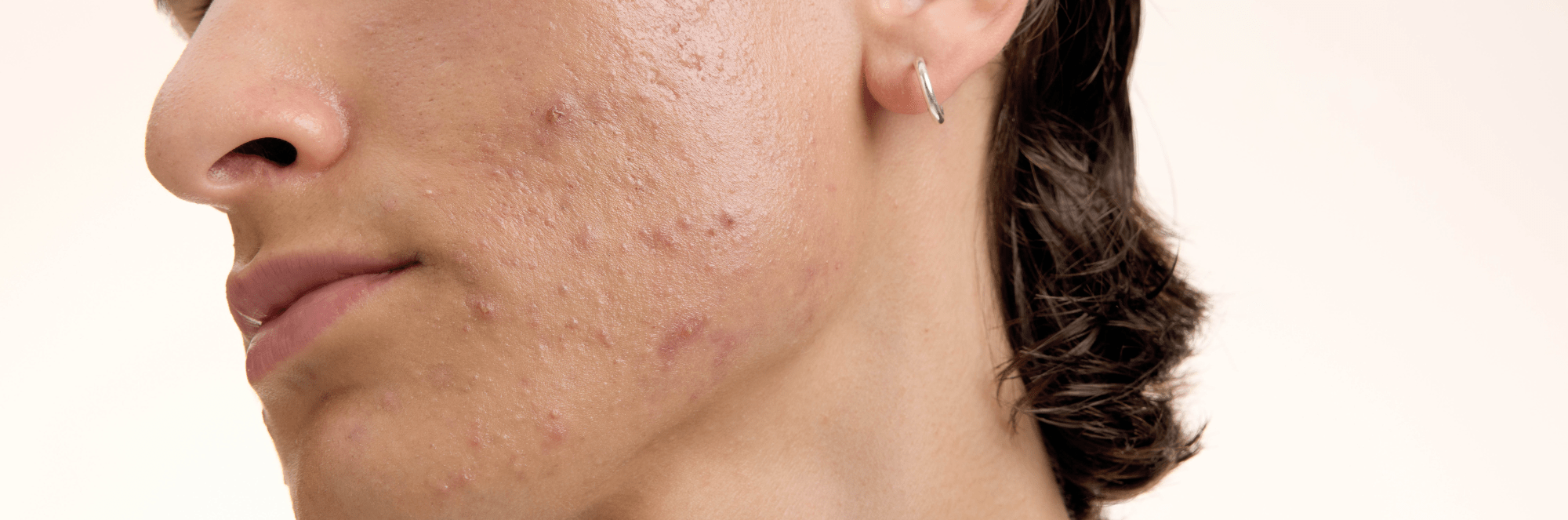 närbild av en mans haka med akne
