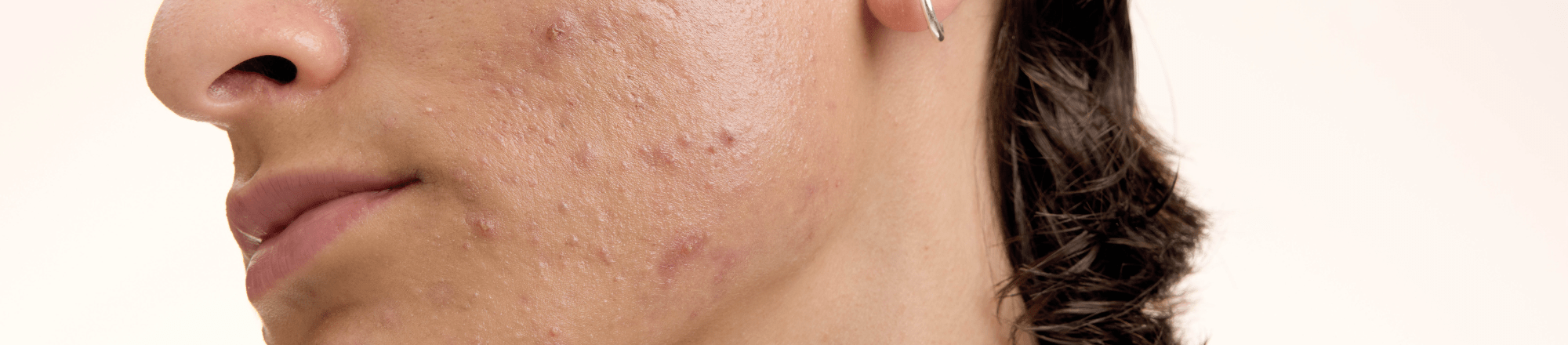 närbild av en mans haka med akne