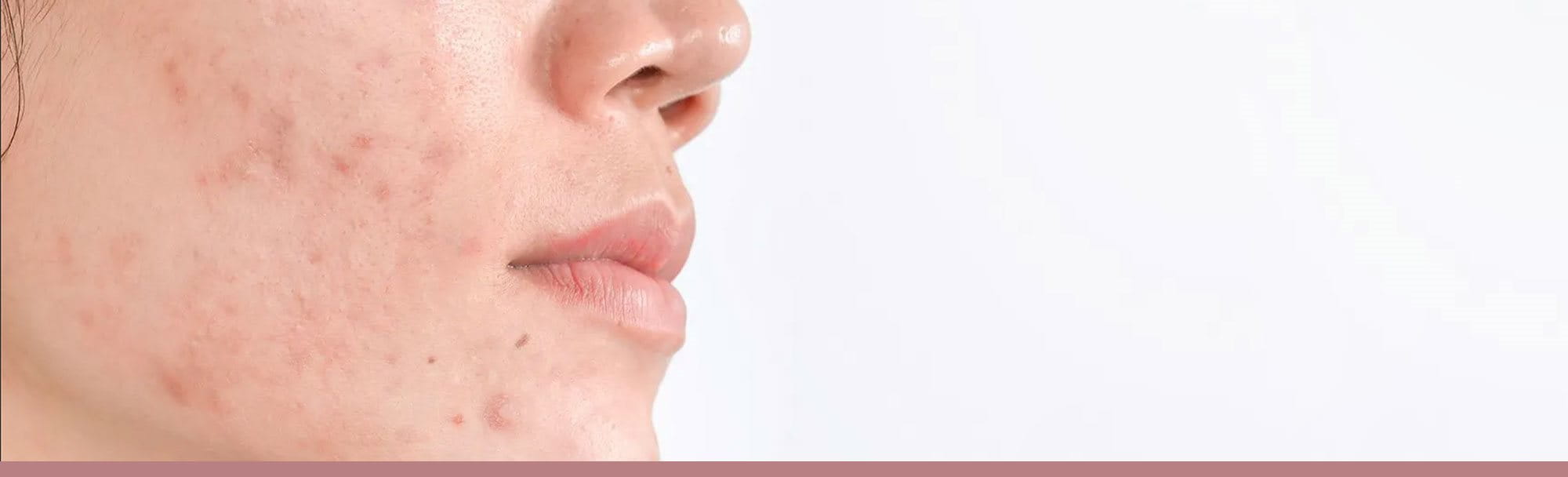 Close-up of a person's face with hyperpigmentation and acne marks.