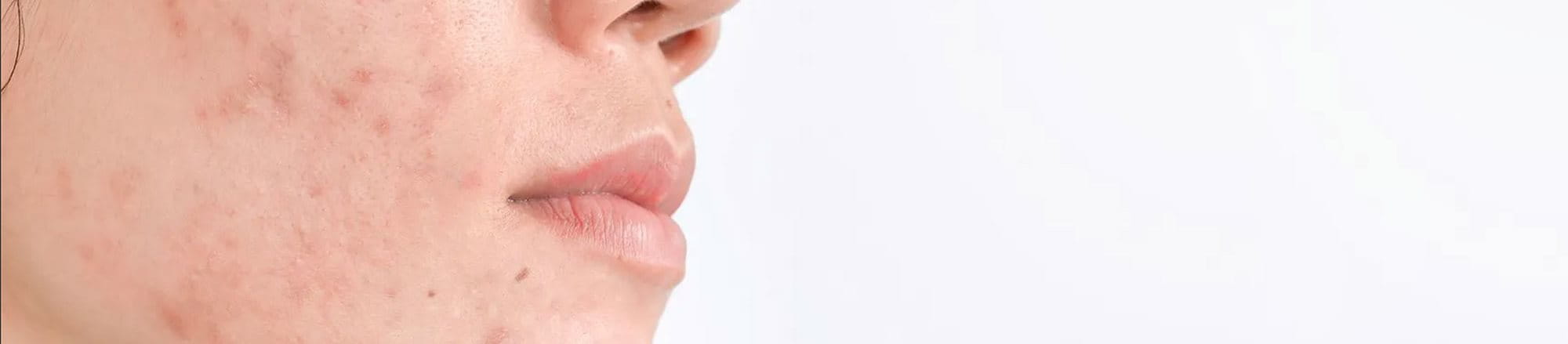 Close-up of a person's face with hyperpigmentation and acne marks.