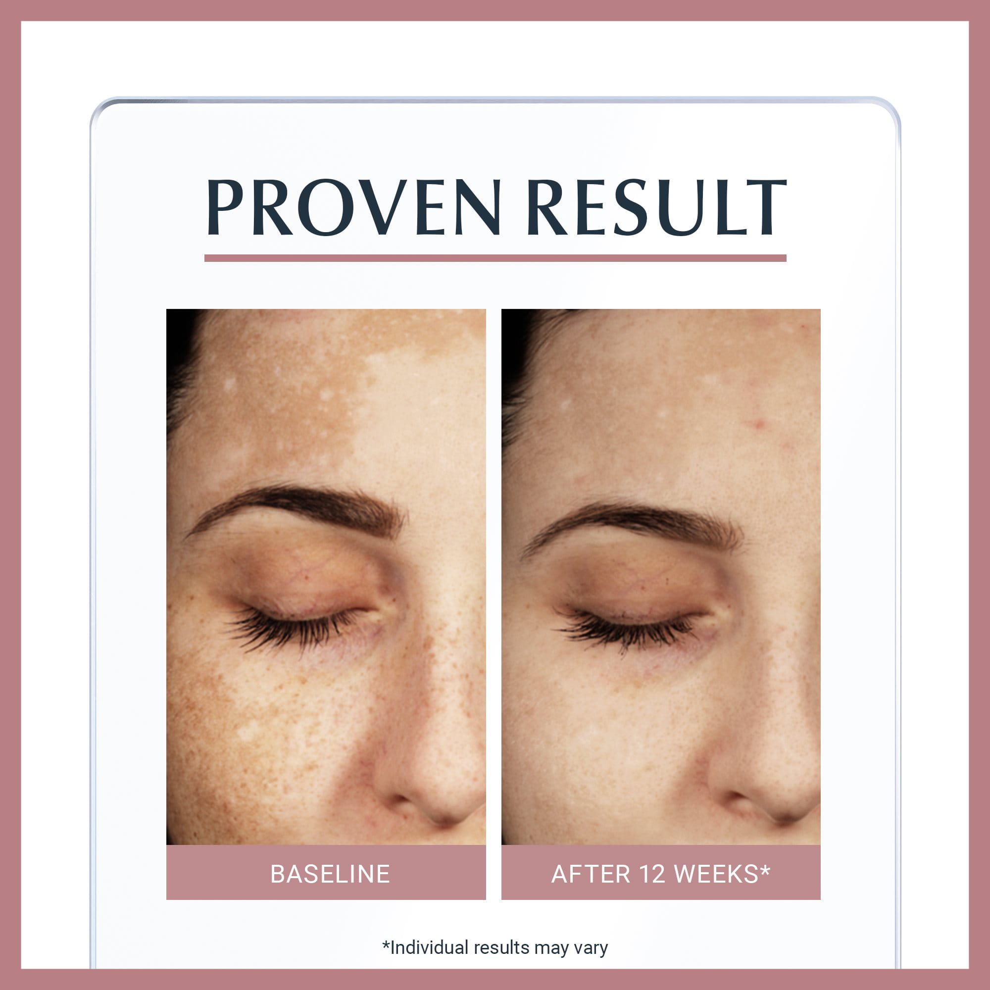 First results of hyperpigmentation reduction are visible in just 12 weeks, showing a reduction of -75%.