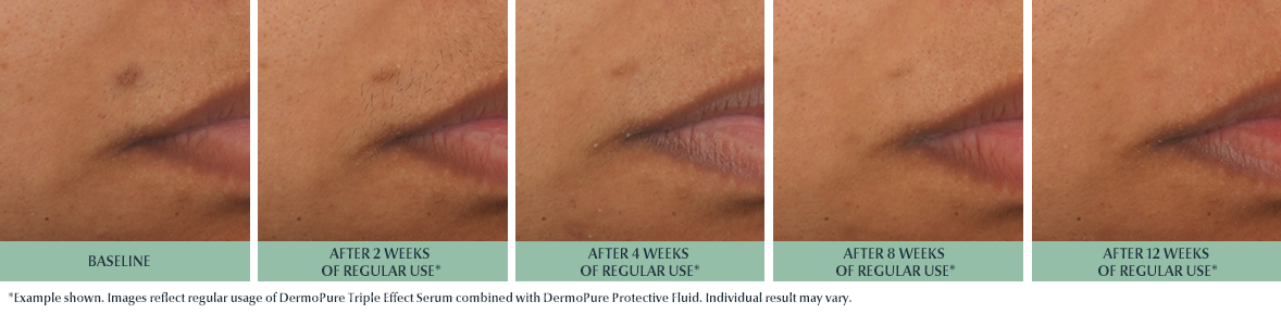 An image showing the impact of the DermoPurifyer Protective Fluid over 12 weeks