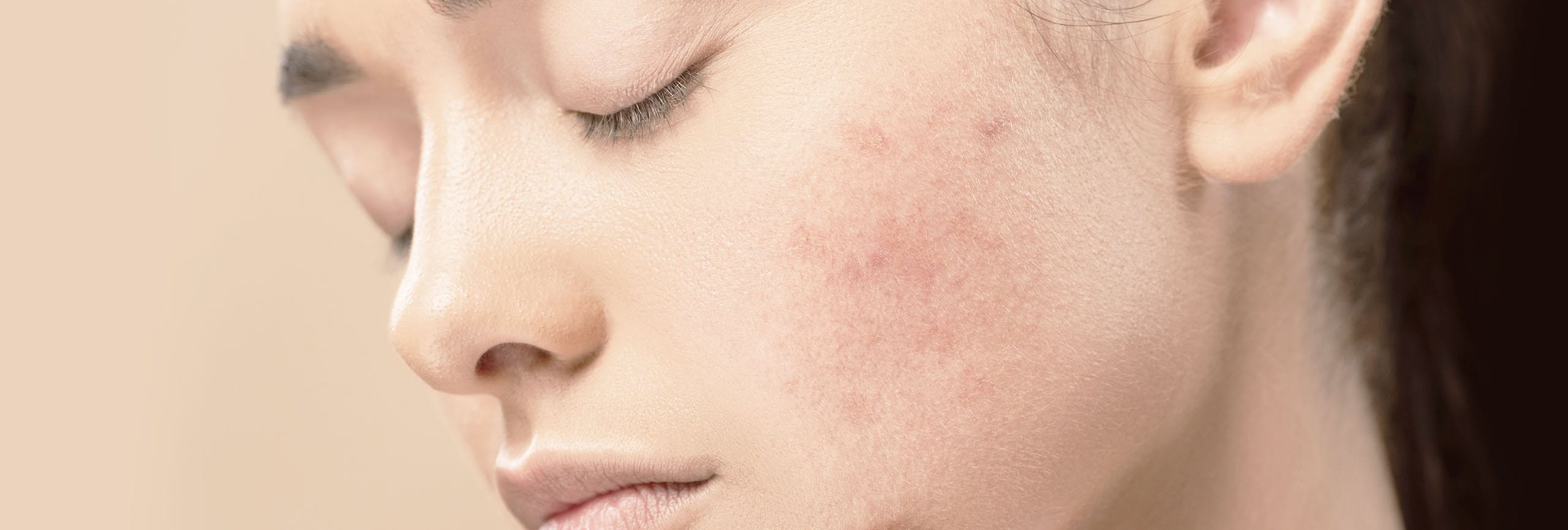 piel con una cicatriz hiperpigmentada