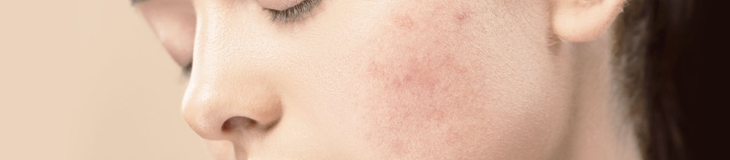 piel con una cicatriz hiperpigmentada