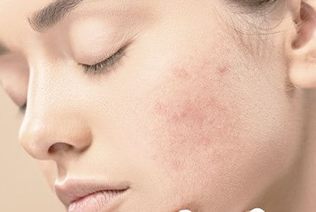 Hiperpigmentación de la piel por cicatriz