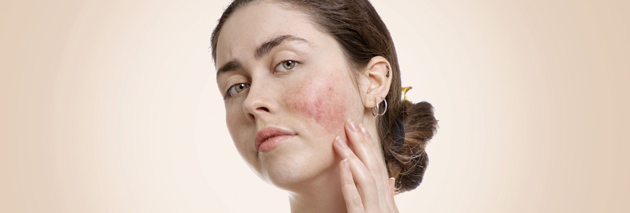 Piel del rostro afectada por rosácea