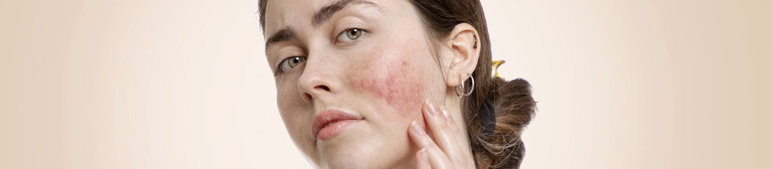 Piel del rostro afectada por rosácea