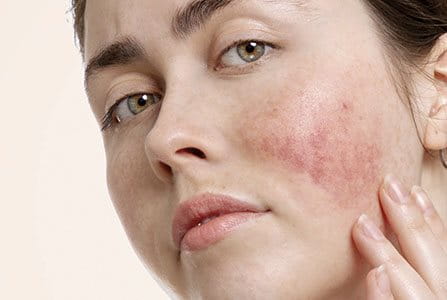 Piel del rostro afectada por rosácea