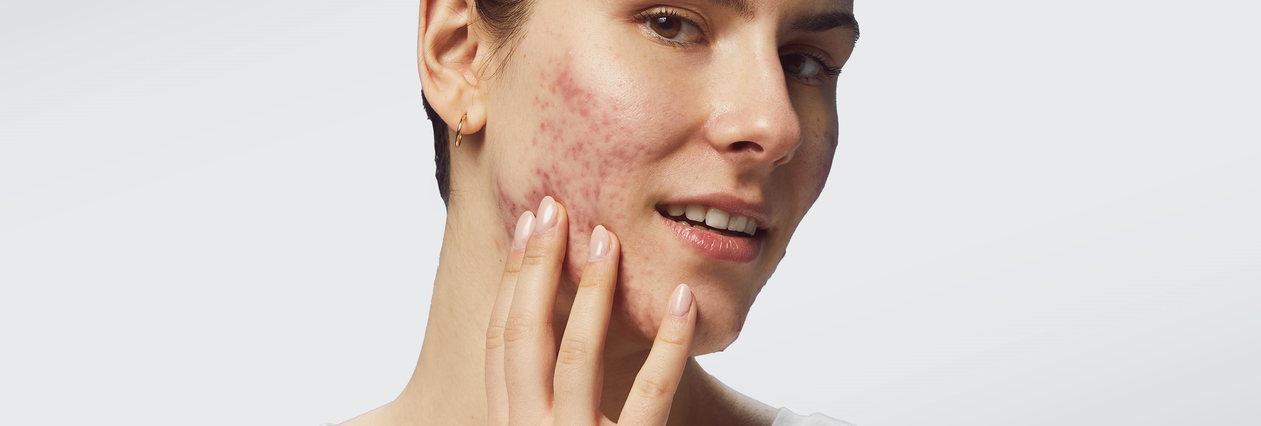 Factores  fundamentales que causan el acné