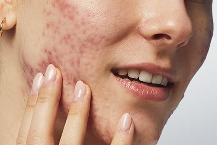 Factores  fundamentales que causan el acné