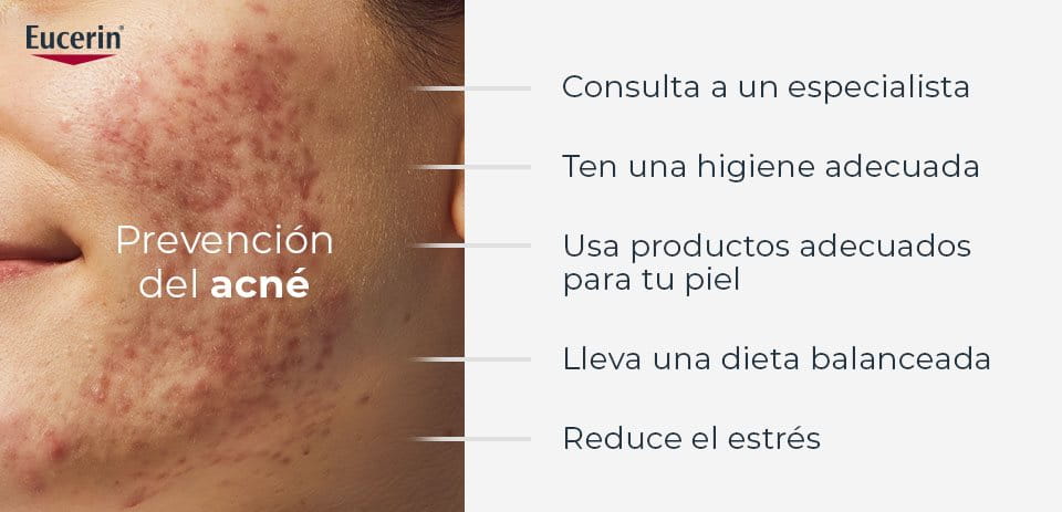 Mujer tratando el acné en su piel
