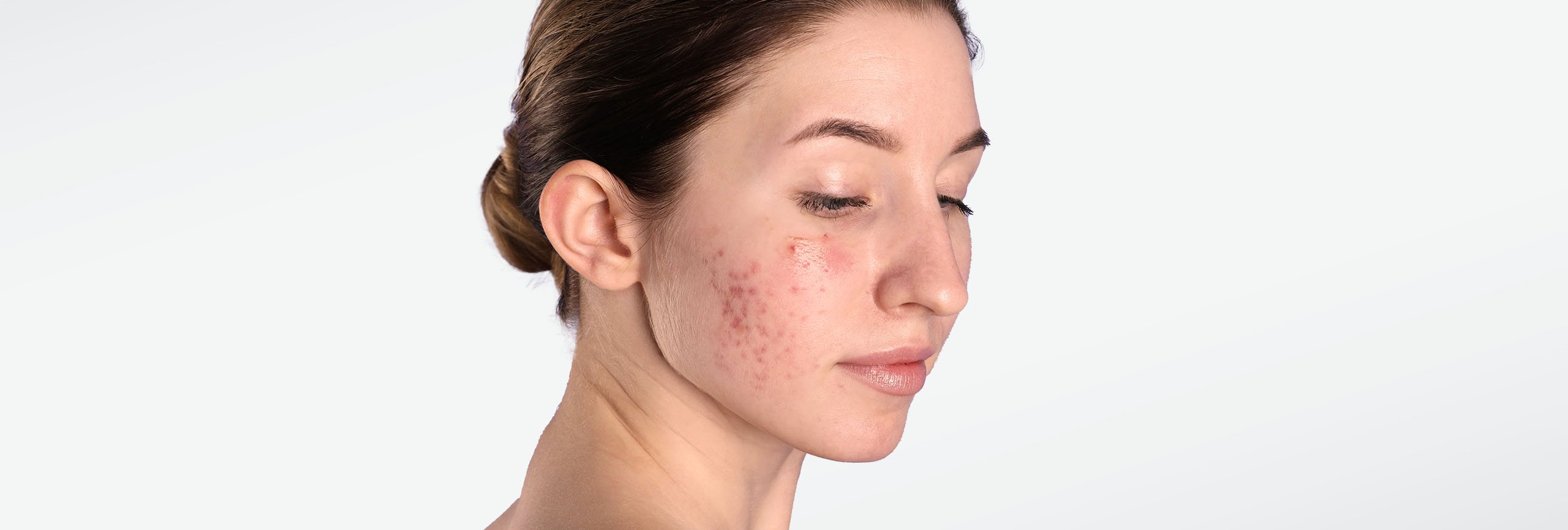 Mujer tratando el acné en su piel