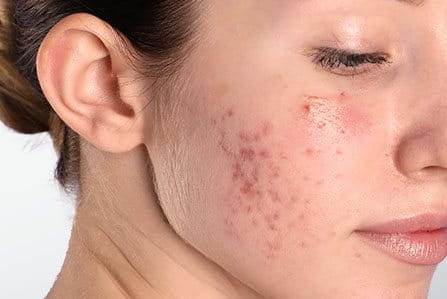 Mujer tratando el acné en su piel