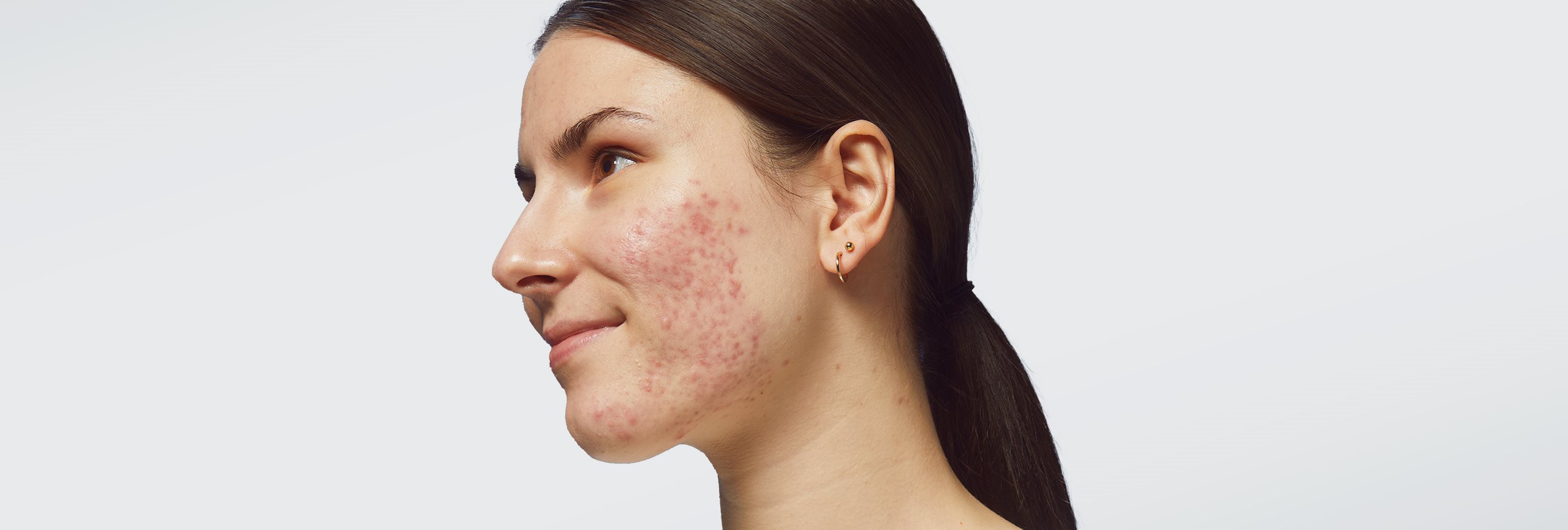 ¿Puede causar acné el estrés?