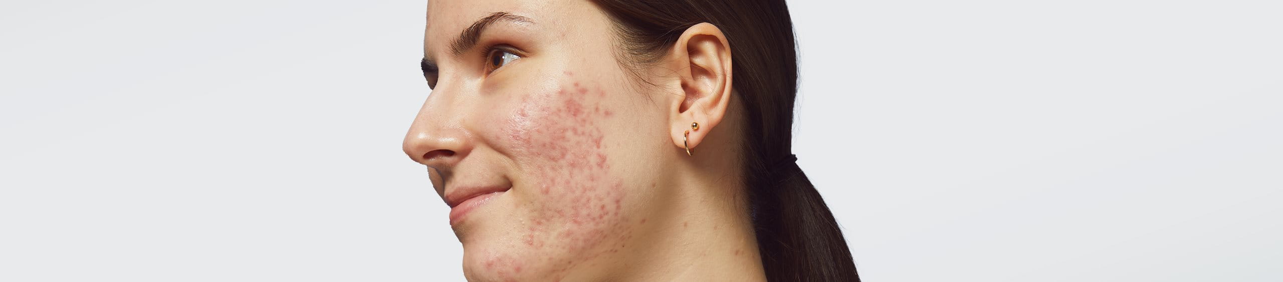 ¿Puede causar acné el estrés?