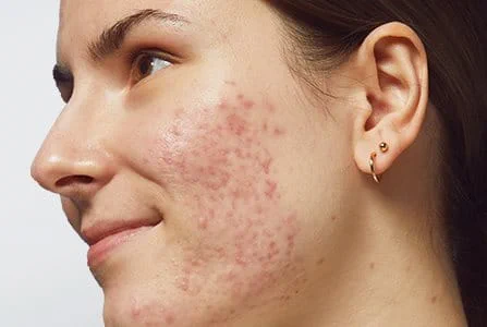 ¿Puede causar acné el estrés?