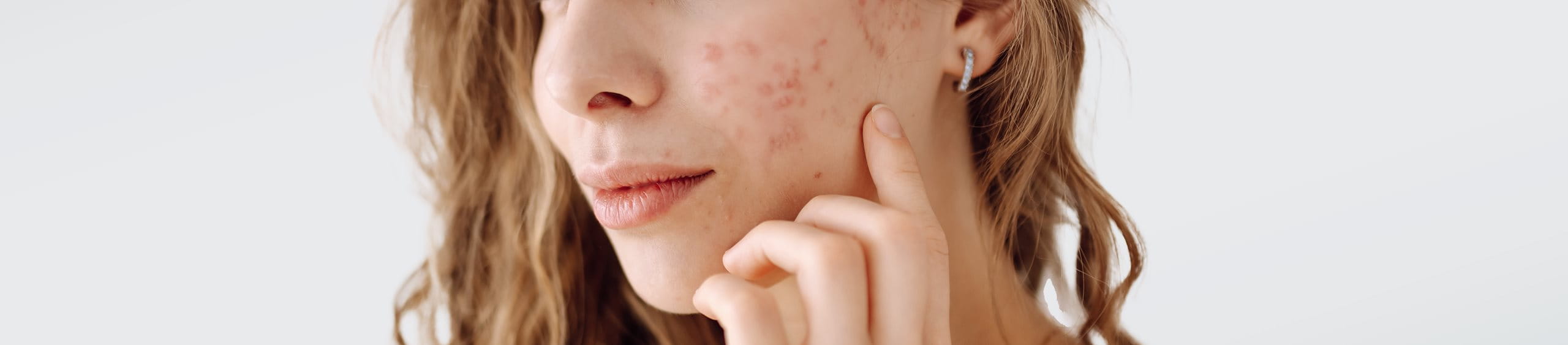 ¿El sol ayuda a reducir el acné?