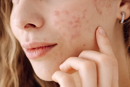 ¿El sol ayuda a reducir el acné?