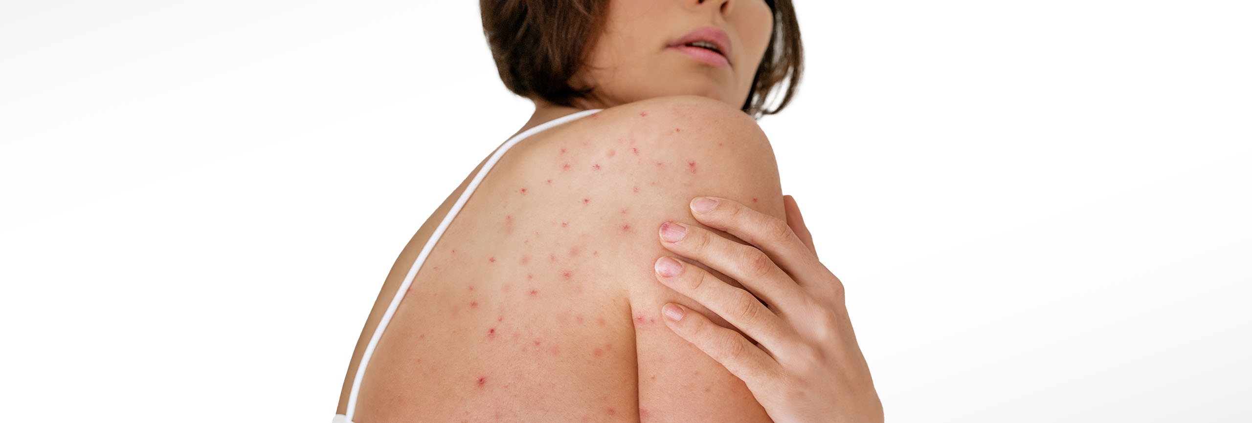 mujer cuidando su piel para evitar queratosis pilaris