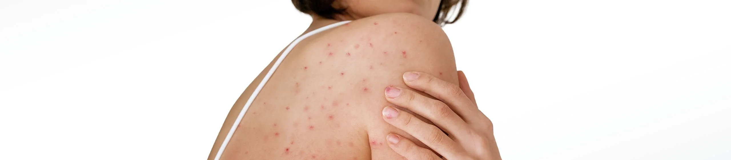 mujer cuidando su piel para evitar queratosis pilaris