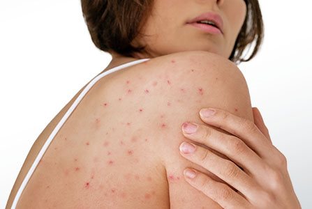 mujer cuidando su piel para evitar queratosis pilaris