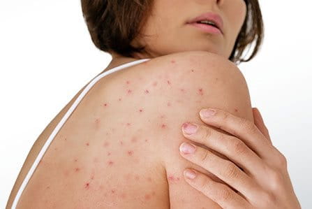 mujer cuidando su piel para evitar queratosis pilaris