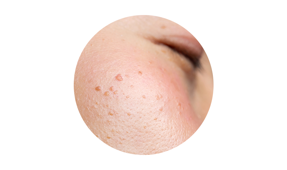 Cara con imperfecciones