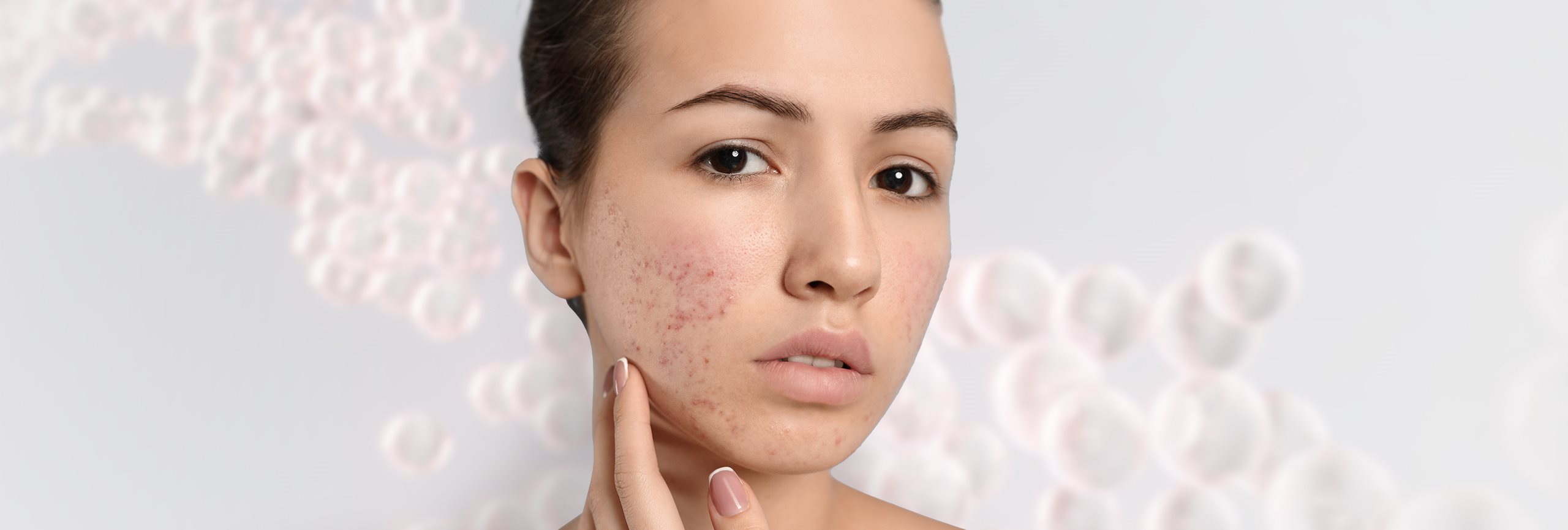 Acne e hiperpigmentação da pele
