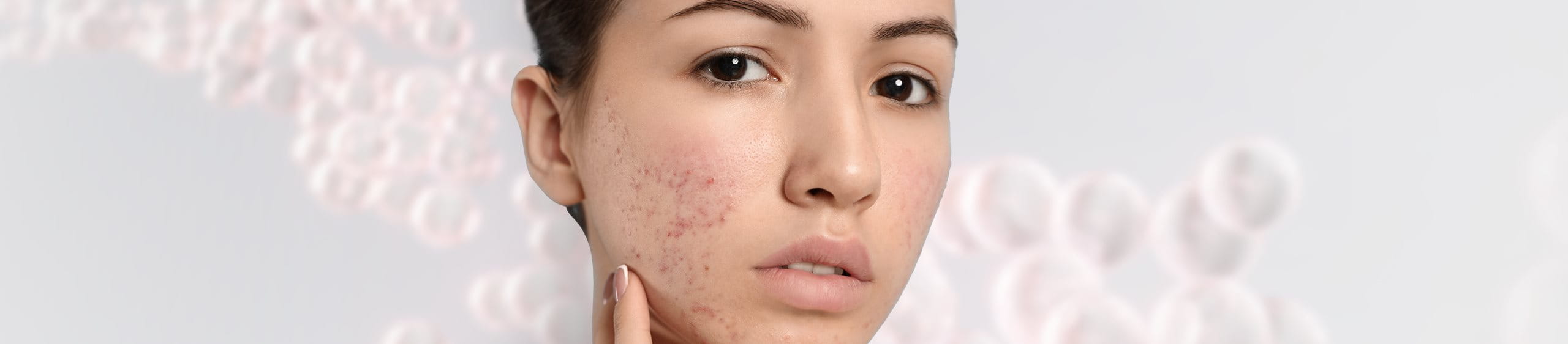Acne e hiperpigmentação da pele