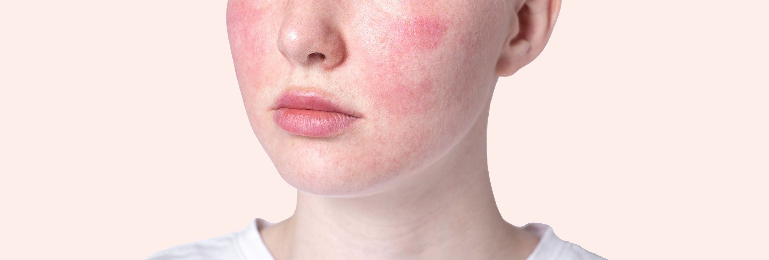 Pele facial afetada pela rosácea